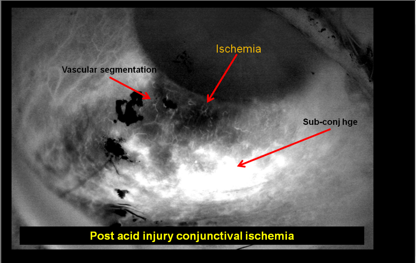 DVI chemical injury ischaemia example