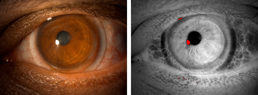 Colour and DVI ocular surface comparison