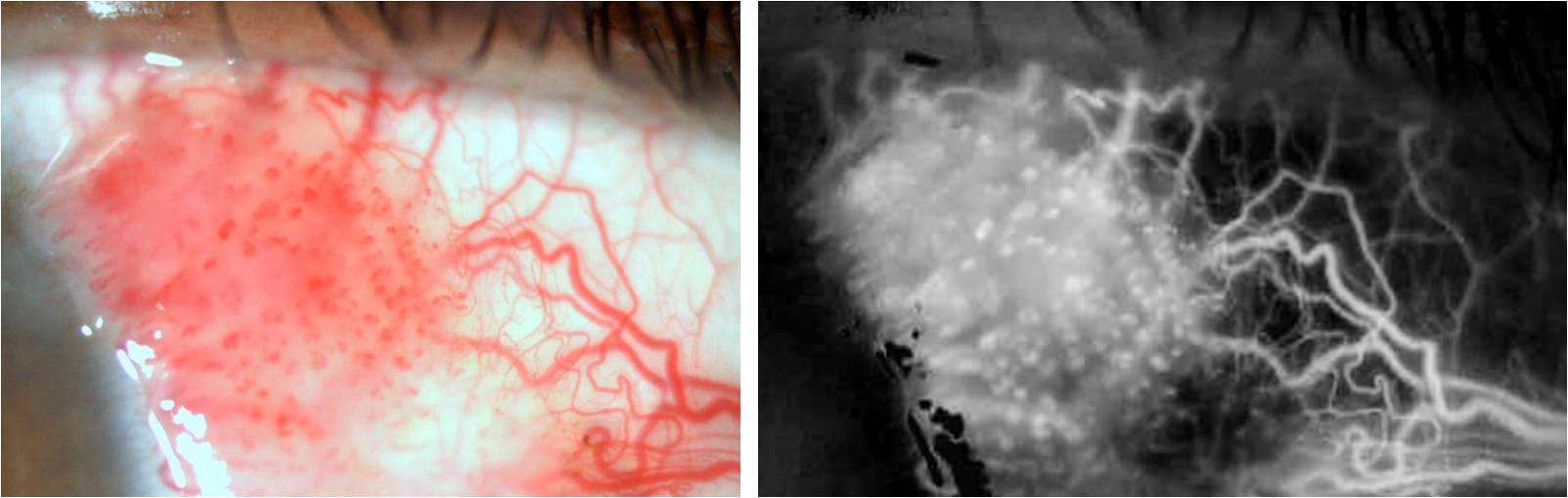 OSSN vascularisation comparison